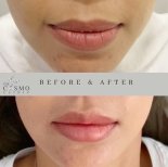 Результаты до и после лип лифтинга в The Cosmo Clinic, улучшенная форма и объем губ