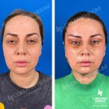 Mini facelift before and after results at Lokman Hekim Istanbul Hospital, facial rejuvenation