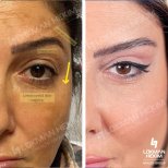 Mini facelift before and after results at Lokman Hekim Istanbul Hospital, visible eye area lift