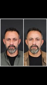 Facelift before and after results at VM Medical Park Pendik Hospital, visible facial rejuvenation