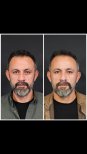 Facelift before and after results at VM Medical Park Pendik Hospital, visible facial rejuvenation