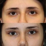 Before and after upper eyelid surgery results at Memorial Şişli Hospital, rejuvenated eyes