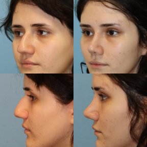 Before and after rhinoplasty results at Memorial Şişli Hospital, nose reshaping procedure