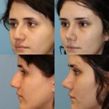 Before and after rhinoplasty results at Memorial Şişli Hospital, nose reshaping procedure