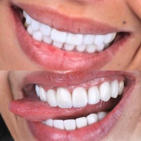 before-after photo viniry-emax