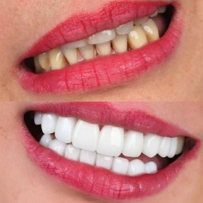 before-after photo viniry-emax