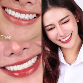before-after photo viniry-emax