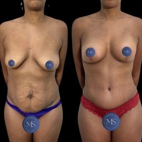 before-after photo breast-augmentation