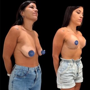 before-after photo breast-augmentation