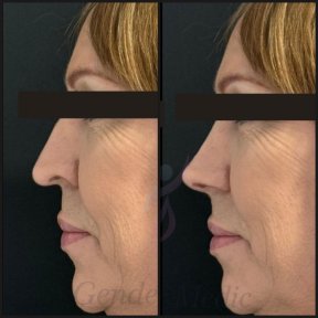 before-after photo rinoplastika-plastika-nosa