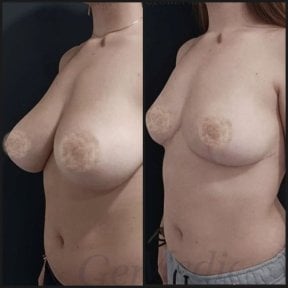 before-after photo umensenie-grudi
