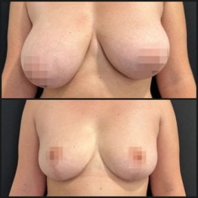 before-after photo umensenie-grudi