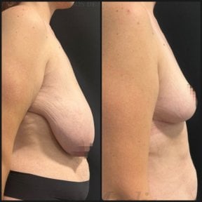 before-after photo mastopeksia-podtazka-grudi-konturnaa-plastika