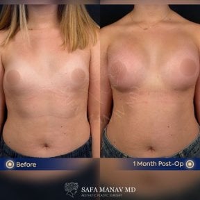 before-after photo uvelicenie-grudi