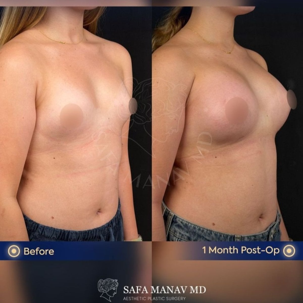 Resultados de aumento de senos antes y después en Dr. Safa Manav Clinic, 1 mes post-op