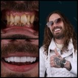 Before and after dental crowns result at Dental Clinic Mira Clinic SAĞLIK TURİZM ŞİRKETİ