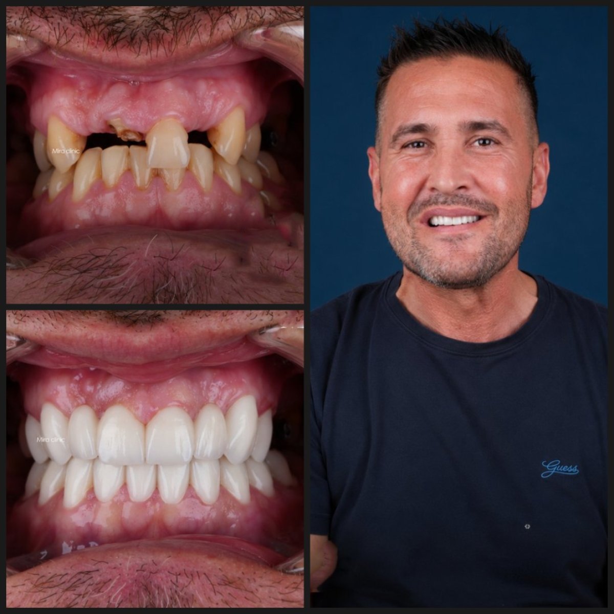 نتائج قبل وبعد تركيب تيجان الأسنان في عيادة Dental Clinic Mira Clinic SAĞLIK TURİZM ŞİRKETİ