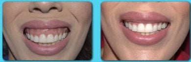 before-after photo gingivectomy