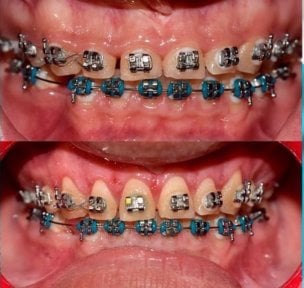 before-after photo gingivectomy