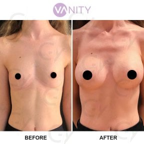 Before and after breast augmentation results at Vanity Cosmetic Surgery Center, enhanced volume