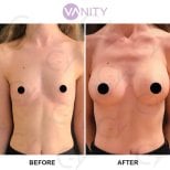 Before and after breast augmentation results at Vanity Cosmetic Surgery Center, enhanced volume