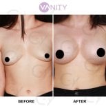 Before and after breast augmentation results at Vanity Cosmetic Surgery Center, fuller breasts