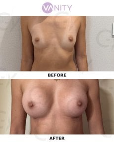 Before and after breast augmentation results at Vanity Cosmetic Surgery Center, fuller breasts