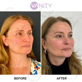 Результати до і після підтяжки обличчя у Vanity Cosmetic Surgery Center, омолодження