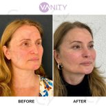 Результати до і після підтяжки обличчя у Vanity Cosmetic Surgery Center, омолодження