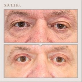 before-after photo tightening-of-facial-skin-facelift