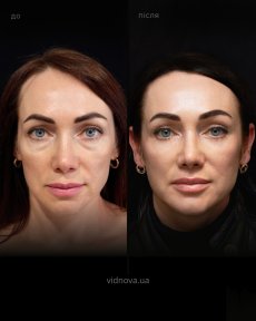 before-after photo lower-eyelid-surgery
