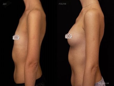 before-after photo mammoplasty