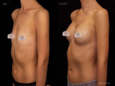 before-after photo mammoplasty