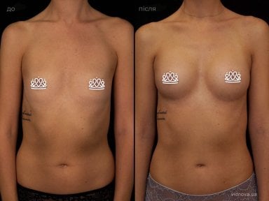 before-after photo mammoplasty