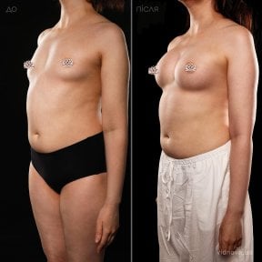 before-after photo mammoplasty