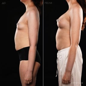 before-after photo mammoplasty