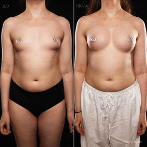 before-after photo mammoplasty