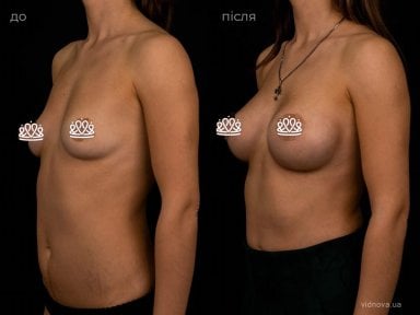 before-after photo mammoplasty