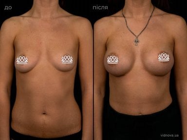 before-after photo mammoplasty