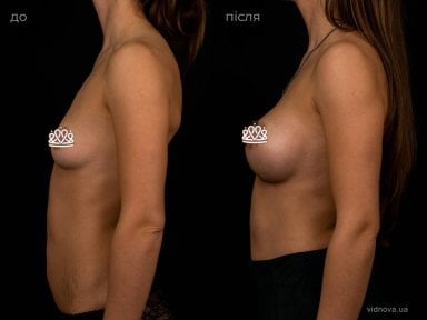 before-after photo mammoplasty
