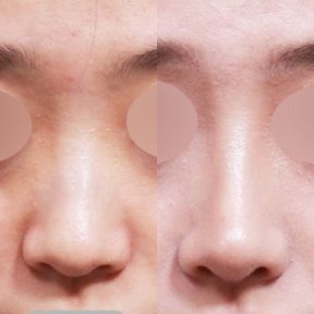 before-after photo tip-rhinoplasty