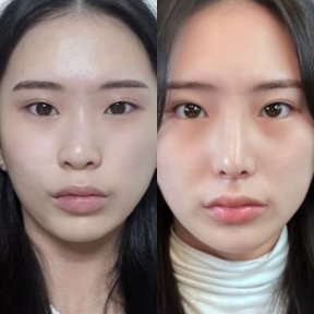 before-after photo tip-rhinoplasty