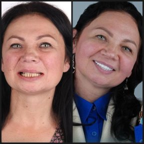 before-after photo otbelivanie-zubov