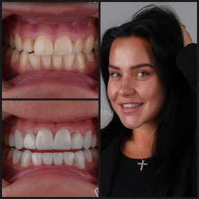 before-after photo otbelivanie-zubov