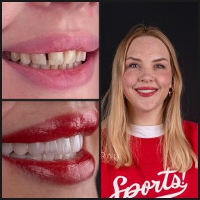 before-after photo otbelivanie-zubov