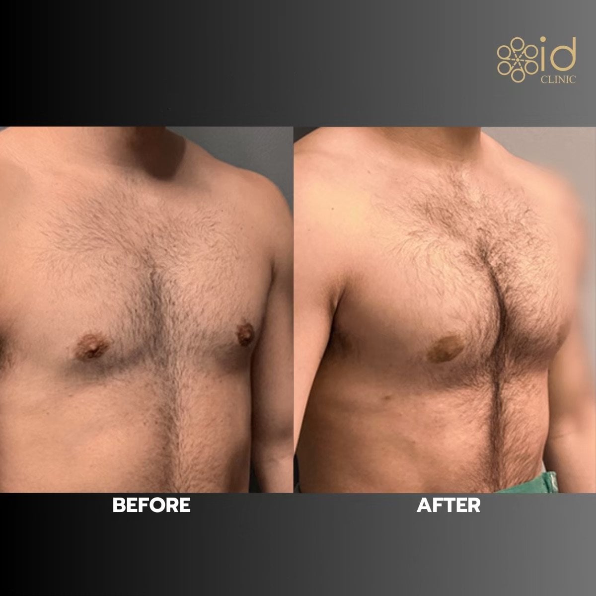 Antes y después de implantes pectorales en ID Clinic Bangkok, resultado de pecho masculino mejorado