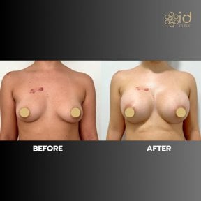 before-after photo breast-augmentation