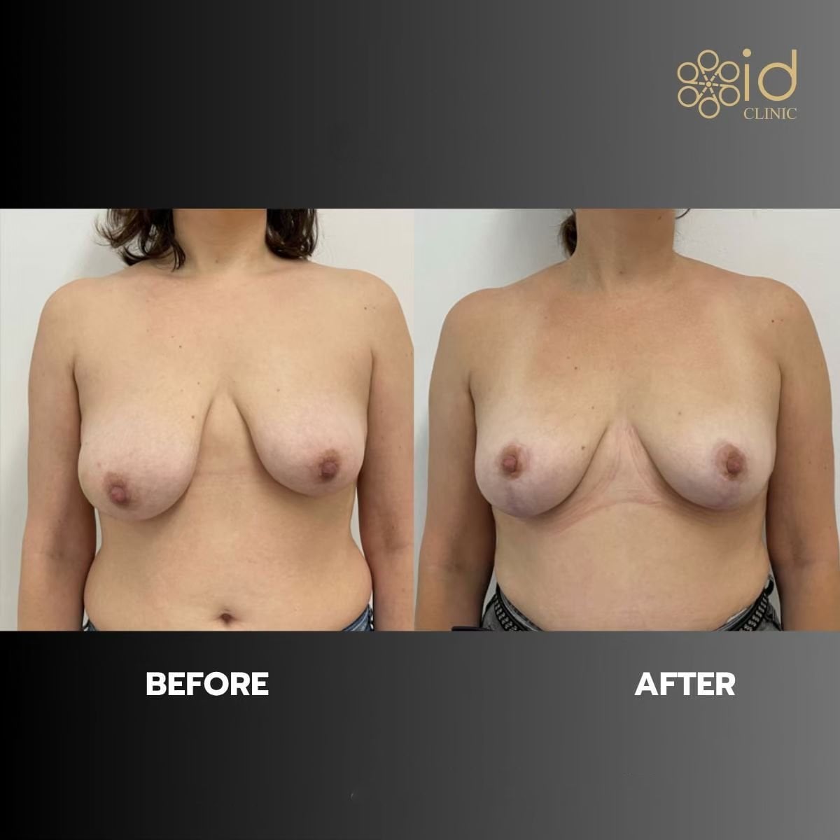 نتائج تصغير الثدي قبل وبعد في ID Clinic Bangkok، تحسين شكل ورفع الثدي