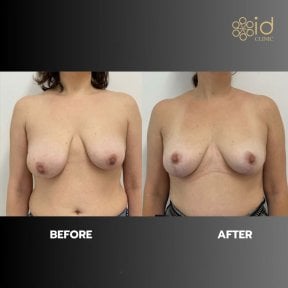 before-after photo breast-reduction
