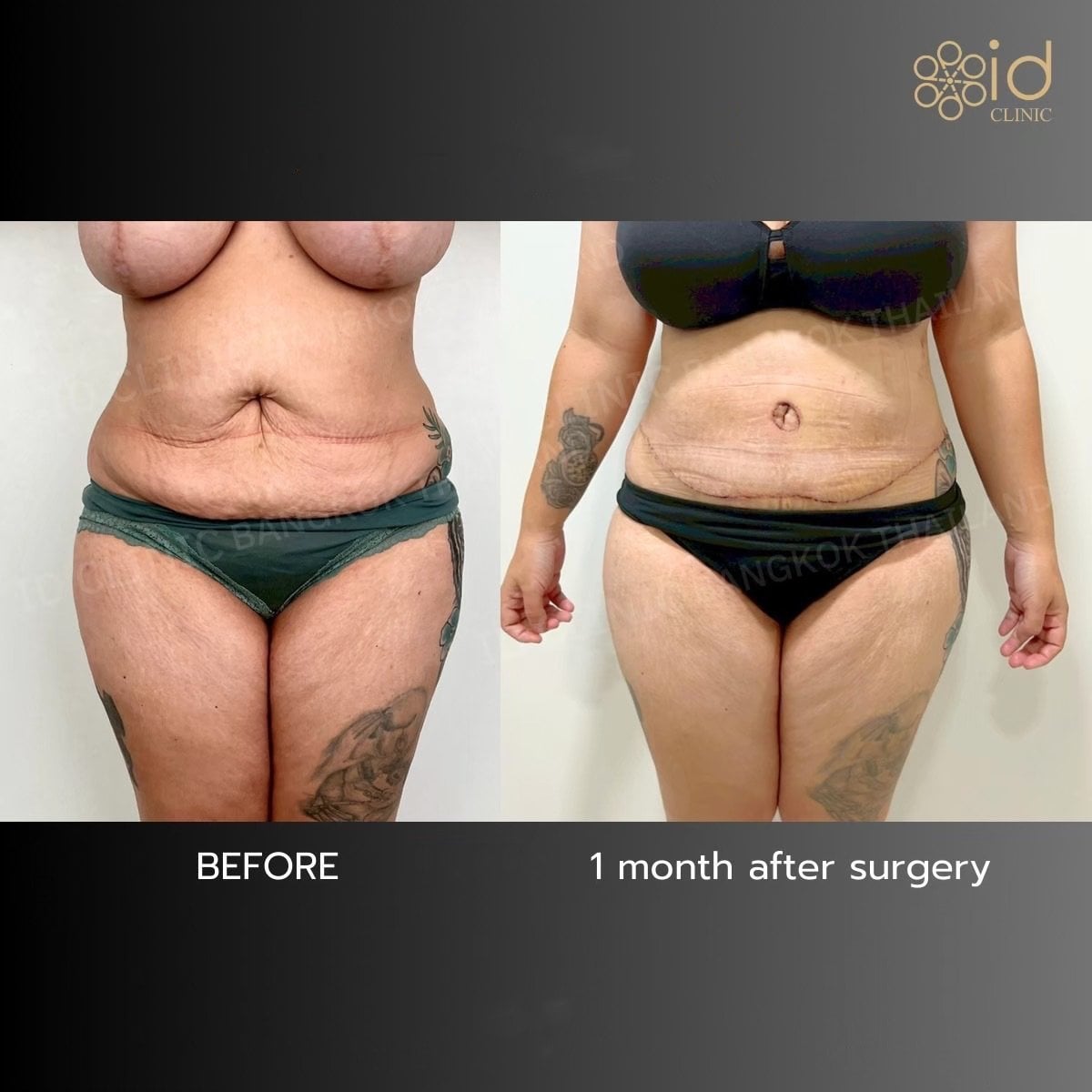 نتائج قبل وبعد عملية تجميل الأم في ID Clinic Bangkok – تحسين واضح لتناسق الجسم